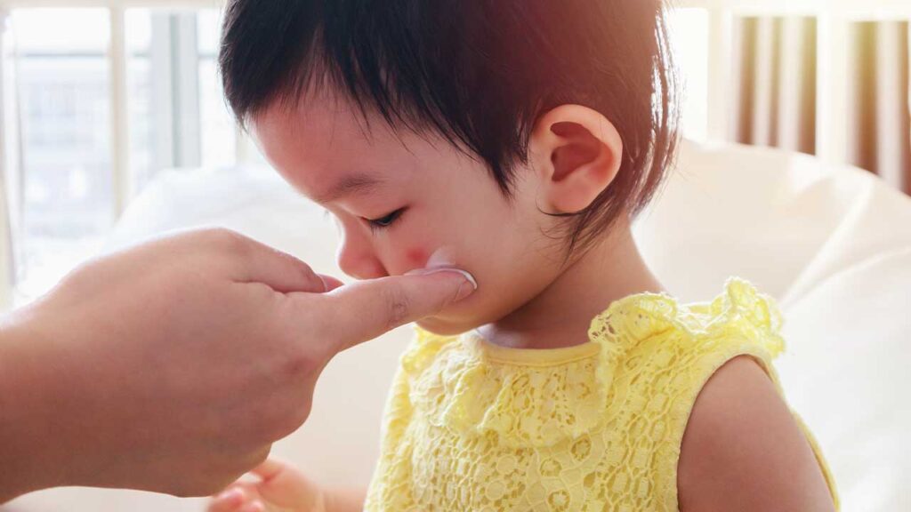Picada de mosquito, formiga ou abelha em bebê? Saiba como agir com segurança